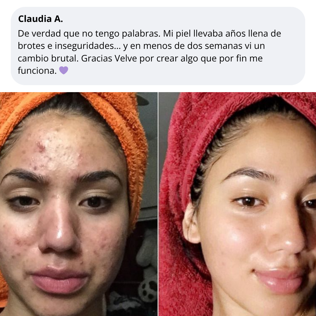 Velve DERMACORE - Suplemento Hormonal Para El Acné