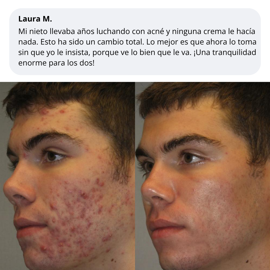 Velve DERMACORE - Suplemento Hormonal Para El Acné