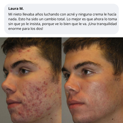 Velve DERMACORE - Suplemento Hormonal Para El Acné