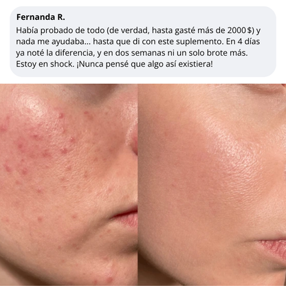 Velve DERMACORE - Suplemento Hormonal Para El Acné