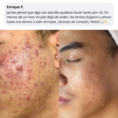 Velve DERMACORE - Suplemento Hormonal Para El Acné