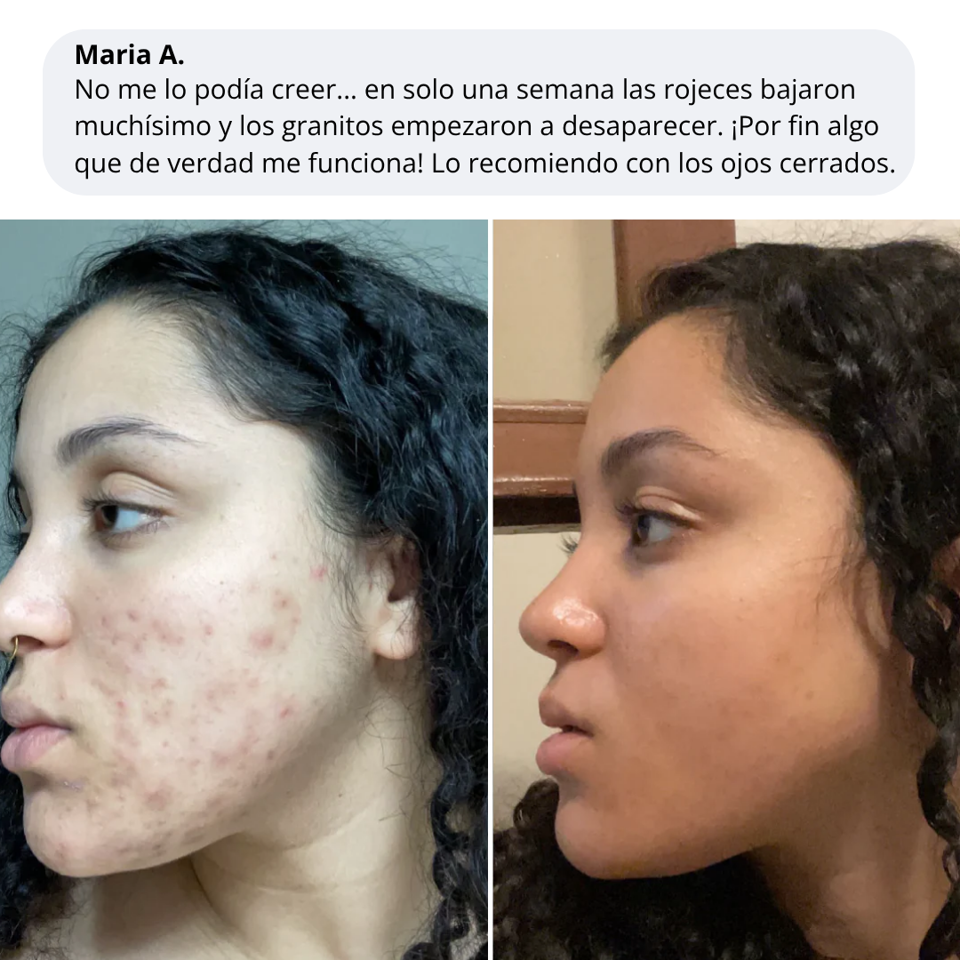 Velve DERMACORE - Suplemento Hormonal Para El Acné